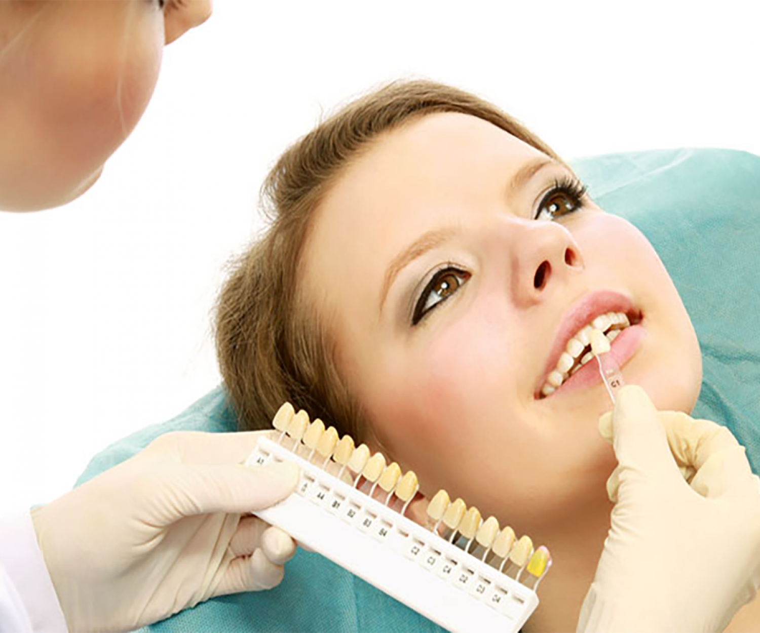 Faccette Dentali