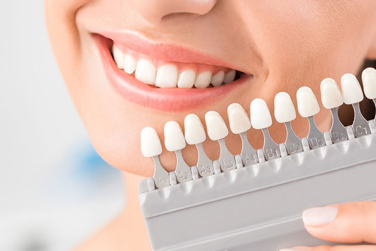 faccette dentali